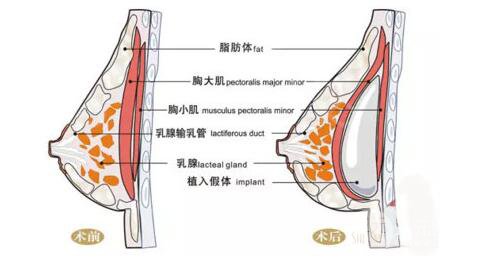 蜜桃假体隆胸的危害性