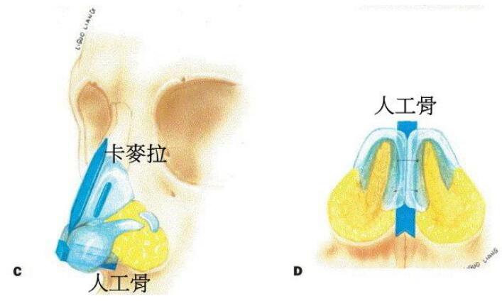 人工骨隆鼻降低风险吗?果能维持多久呢?