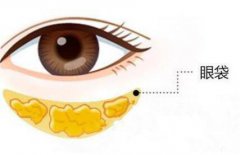 微创去眼袋恢复要多久?具有哪些优势呢?