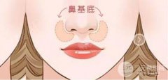 肋骨垫鼻基底会移位吗?专家解答美鼻人群疑惑 肋骨垫鼻基底会移位吗?专家解答美鼻人群疑惑