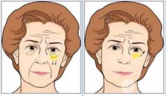 内吸去眼袋能保持多久?术后注意事项有哪些?