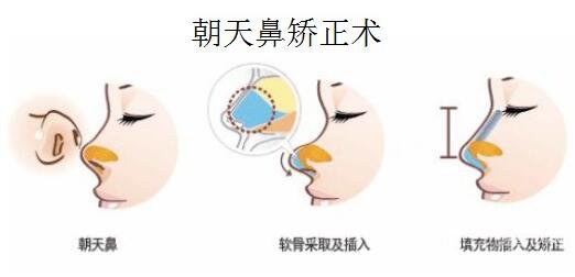 朝天鼻整形果能保持多久?专业解答不再疑惑