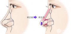 鼻子歪了如何矫正?修复矫正宝典在此! 鼻子歪了如何矫正?修复矫正宝典在此!