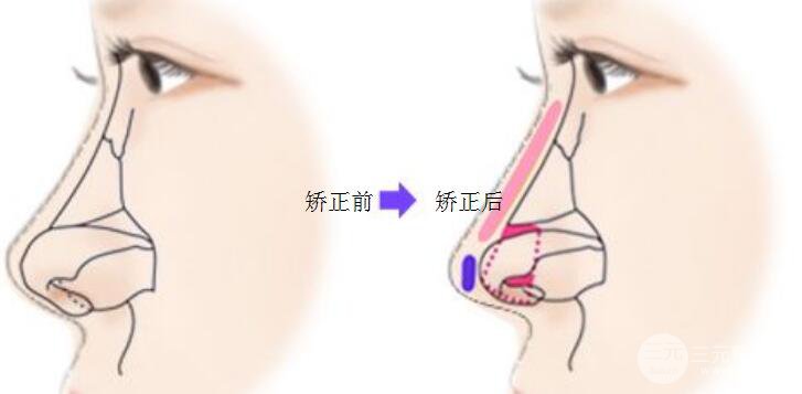 鼻子歪了如何矫正？修复矫正宝典在此！