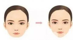 玻尿酸垫下巴维持多久?术后护理工作怎么做?