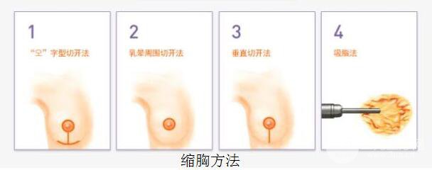 缩胸手术一般多少钱?影响价格的因素你都知道吗?