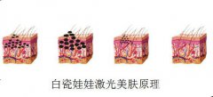白瓷娃娃激光美肤后能吗？多久能化妆？打造自然**肌肤靠护理