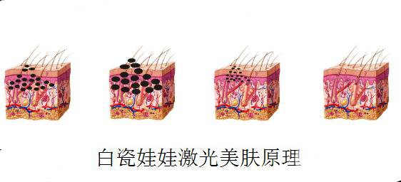 白瓷娃娃激光美肤后能吗?多久能化妆?打造自然**肌肤靠护理