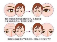 注射瘦脸除皱能维持多久?怎样延**果? 注射瘦脸除皱能维持多久?怎样延**果?