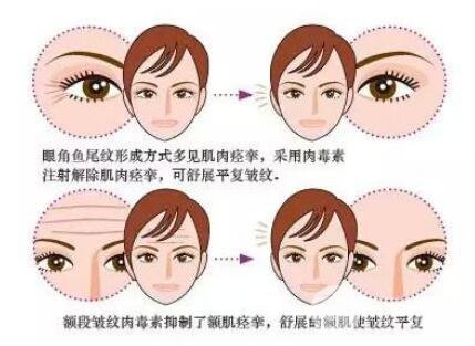 注射瘦脸除皱能维持多久?怎样延**果?