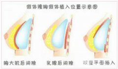 妙桃琴面丰胸痛吗?妙桃丰胸假体具有哪些优势?