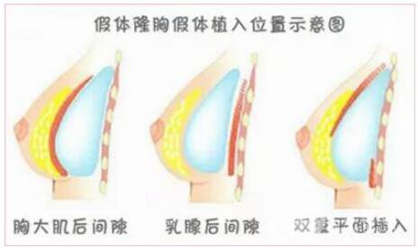 妙桃琴面丰胸痛吗?妙桃丰胸假体具有哪些优势?