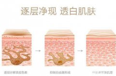 复合彩光祛斑要多久恢复?影响恢复时间的因素有哪些?
