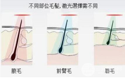成都腋下激光脱毛的价格贵吗?激光脱毛多少钱?