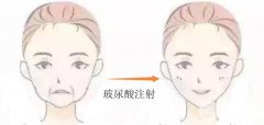 玻尿酸注射去皱费用是多少?价格差异在哪 玻尿酸注射去皱费用是多少?价格差异在哪