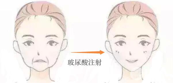 皱纹的存在，说明面部皮肤正在老化