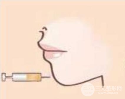 下巴注射物取出价格贵不贵?影响因素主要有?