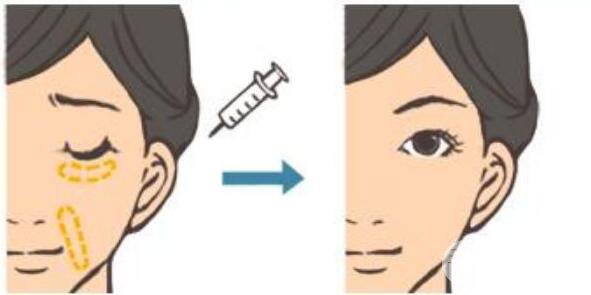 瑞蓝透明质酸一支需要多少钱?价格影响标准是?
