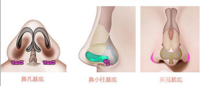 垫鼻基底手术危险吗？盘点术后护理注意事项