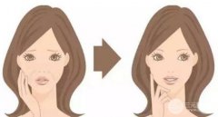 做了彩光嫩肤注意事项？术后怎样更好维持果