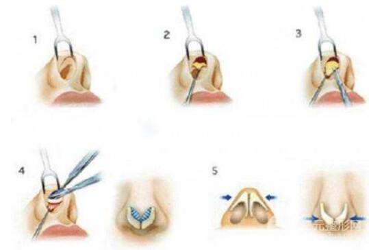 鼻头缩窄怎么做的?手术过程是怎样的?