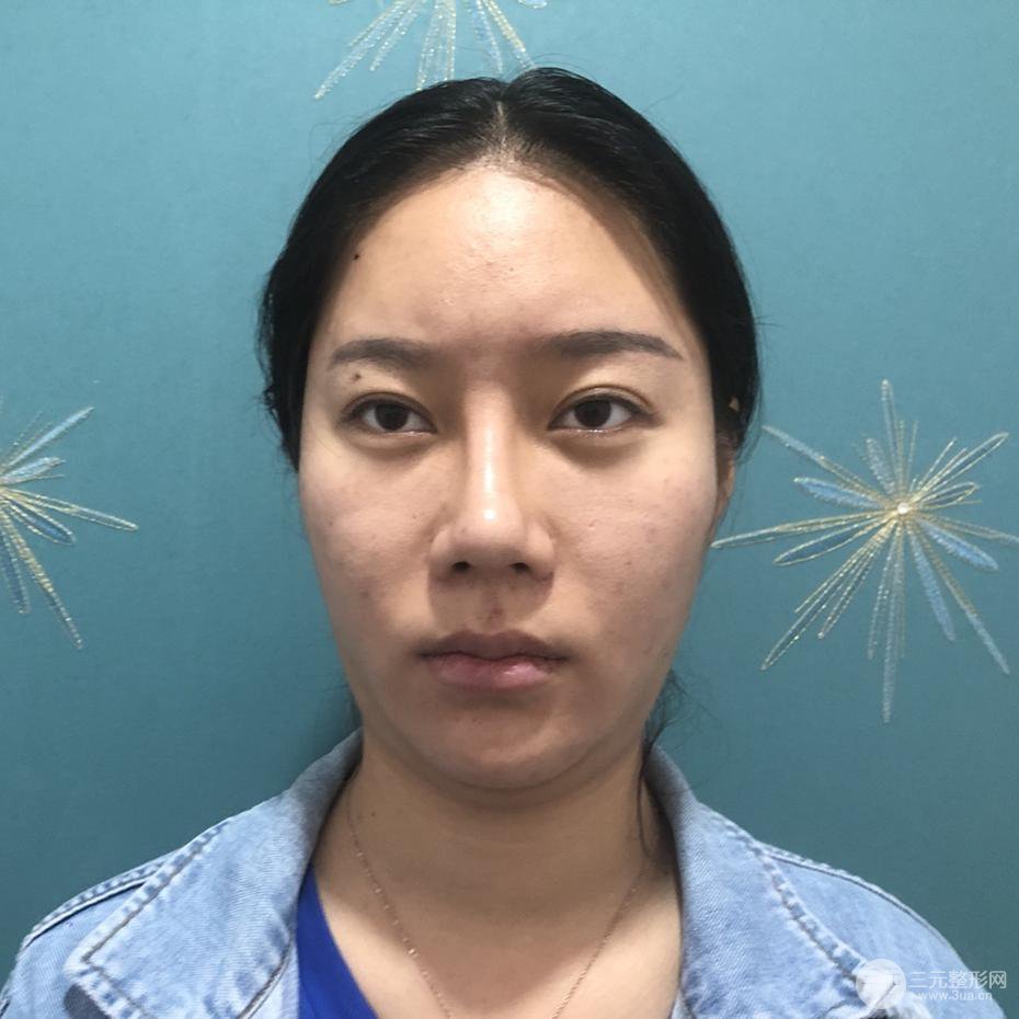 面部吸脂瘦脸