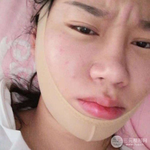 面部吸脂瘦脸