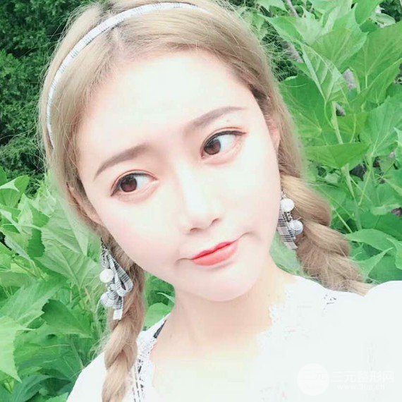 面部吸脂瘦脸