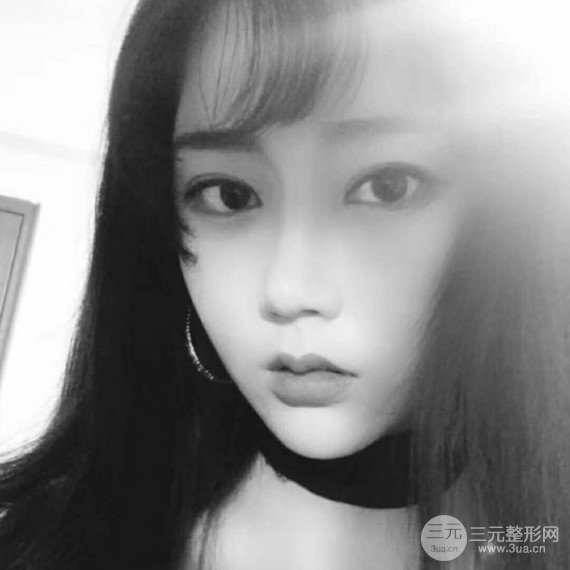 面部吸脂瘦脸