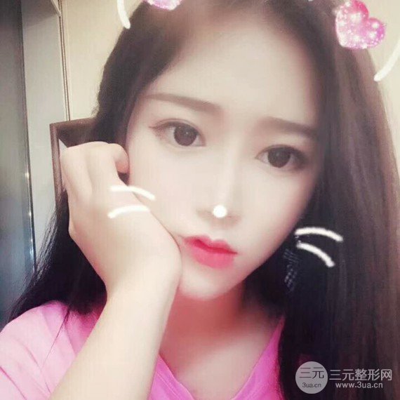 面部吸脂瘦脸