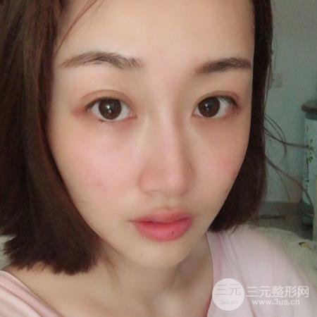 【术后3天即可上妆】大V.线 定点提拉 让脸“嘭嘭嘭”！