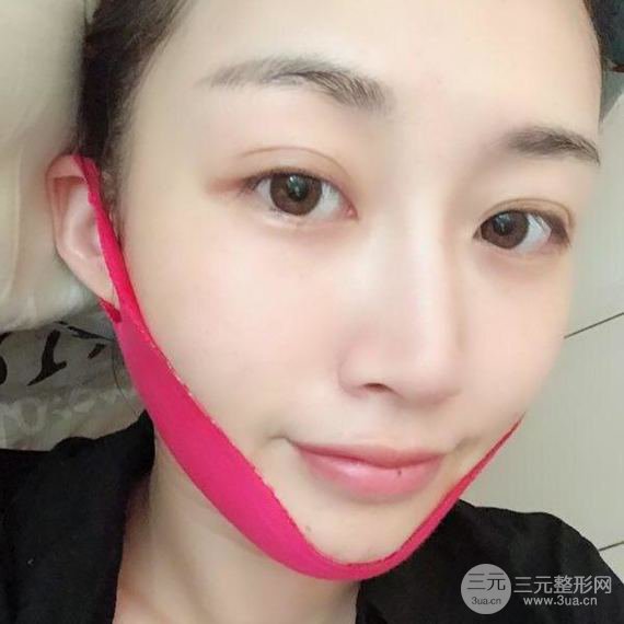 【术后3天即可上妆】大V.线 定点提拉 让脸“嘭嘭嘭”！