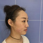 【埋埋提升术后3天即可上妆】大V.线 定点提拉 让脸“嘭嘭嘭”！