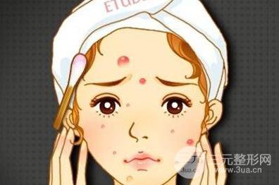 复合彩光去痘要做几次才能有祛除？