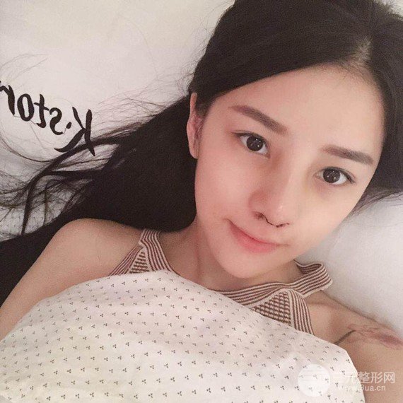 【隆鼻整形+进口假体+耳软骨垫鼻尖+鼻头鼻翼缩小+鼻尖延长】综合改良!