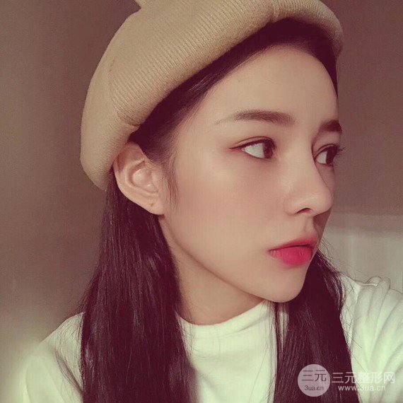 【隆鼻整形+进口假体+耳软骨垫鼻尖+鼻头鼻翼缩小+鼻尖延长】综合改良!