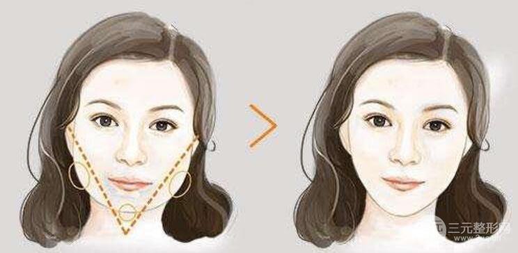 下颌角切除费用要多少？怎么护理？