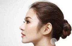 广州美莱隆鼻怎么样?多少钱?