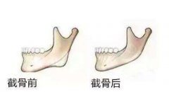 一般削骨大概多少钱？影响价格的因素有哪些？