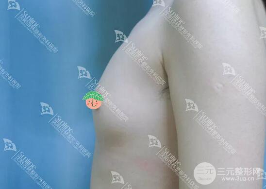 隆胸手术恢复日记:二次元少女晋级美艳胸模