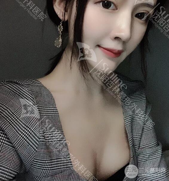 隆胸手术恢复日记:二次元少女晋级美艳胸模