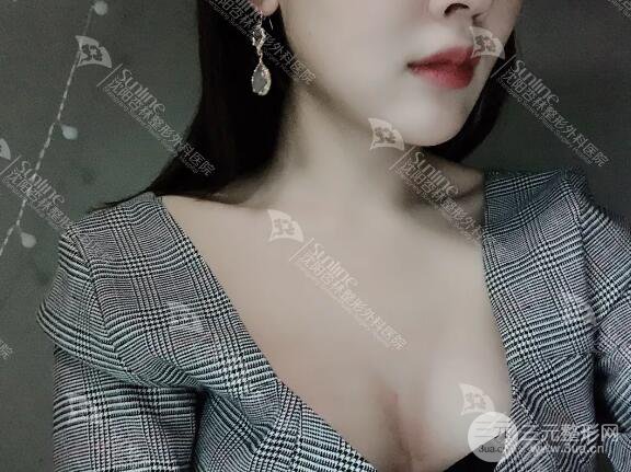 隆胸手术恢复日记:二次元少女晋级美艳胸模