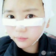 【假体丰太阳穴】如果脂肪满足不了你 那么就选假体太阳穴吧