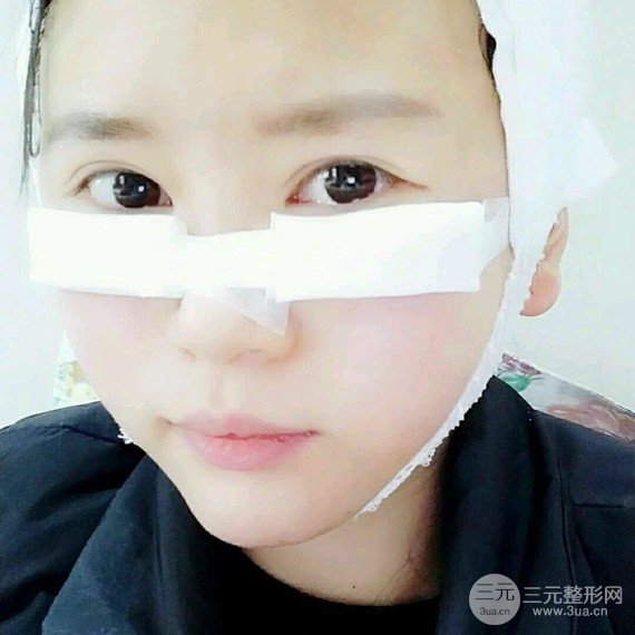 【假体丰太阳穴】如果脂肪满足不了你 那么就选假体太阳穴吧