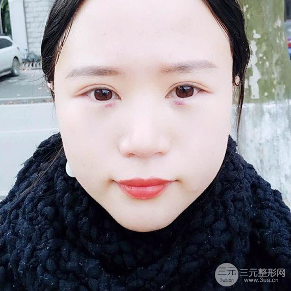 【假体丰太阳穴】如果脂肪满足不了你 那么就选假体太阳穴吧