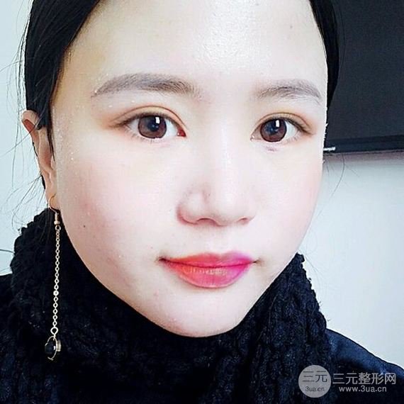 【假体丰太阳穴】如果脂肪满足不了你 那么就选假体太阳穴吧