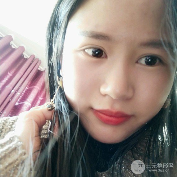 【假体丰太阳穴】如果脂肪满足不了你 那么就选假体太阳穴吧