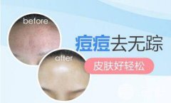 红蓝光祛痘果怎么样？术后注意事项有哪些？