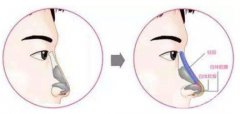 鼻中隔软骨隆鼻有没有什么后遗症?有后遗症吗? 鼻中隔软骨隆鼻有没有什么后遗症?有后遗症吗?