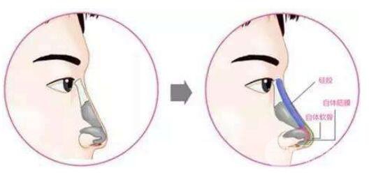 鼻中隔软骨隆鼻有没有什么后遗症?有后遗症吗?